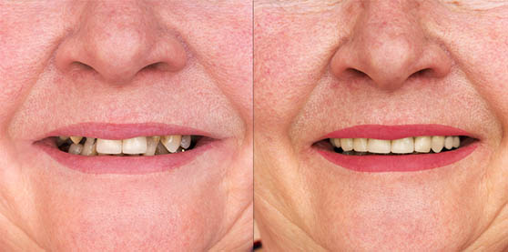 Dental Crowns | Dentistry Of Orlando