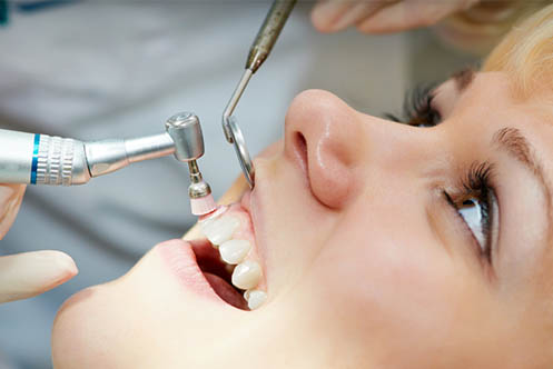 Polising | Dental Cleaning | Dentistry Of Orlando