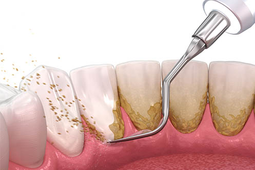 Scaling | Dental Cleaning | Dentistry Of Orlando