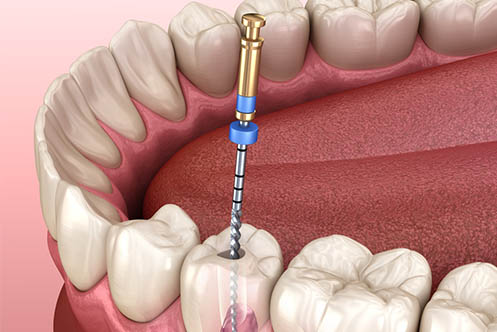Root Canal Preparation Cleaning Dentistry Of Orlando | Dentistry Of Orlando Root Canal Treatment Preparation | Dentistry Of Orlando