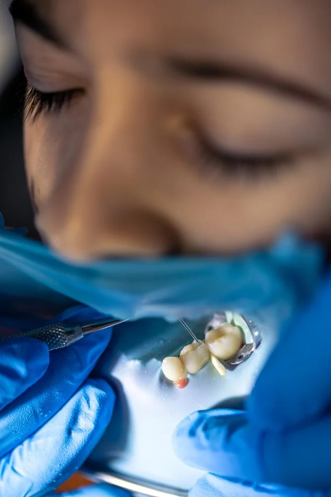 Porcelain Crowns in Orlando - Dentistry of Orlando