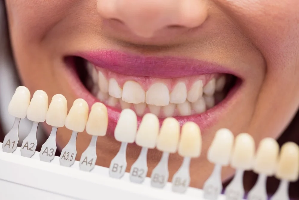 Teeth Whitening Services in Orlando - Dentistry of Orlando