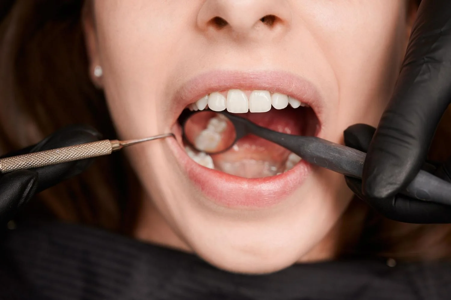 What is a Composite Filling - Dentistry of Orlando
