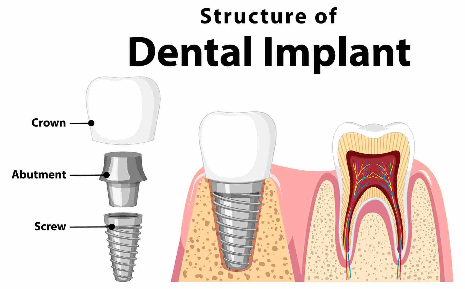 Types of Dental Implants - Dentistry of Orlando