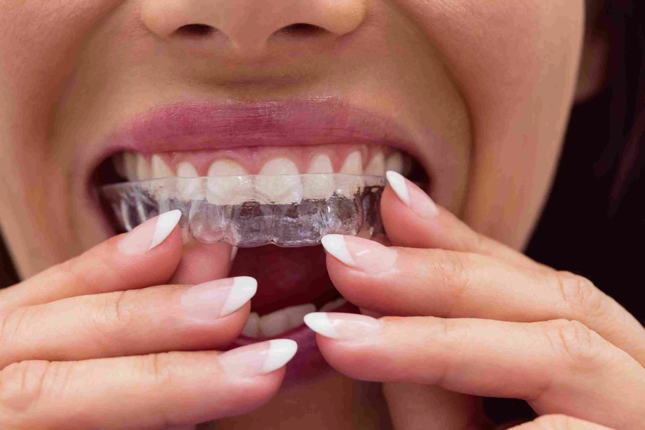 Invisalign - Dentistry of Orlando