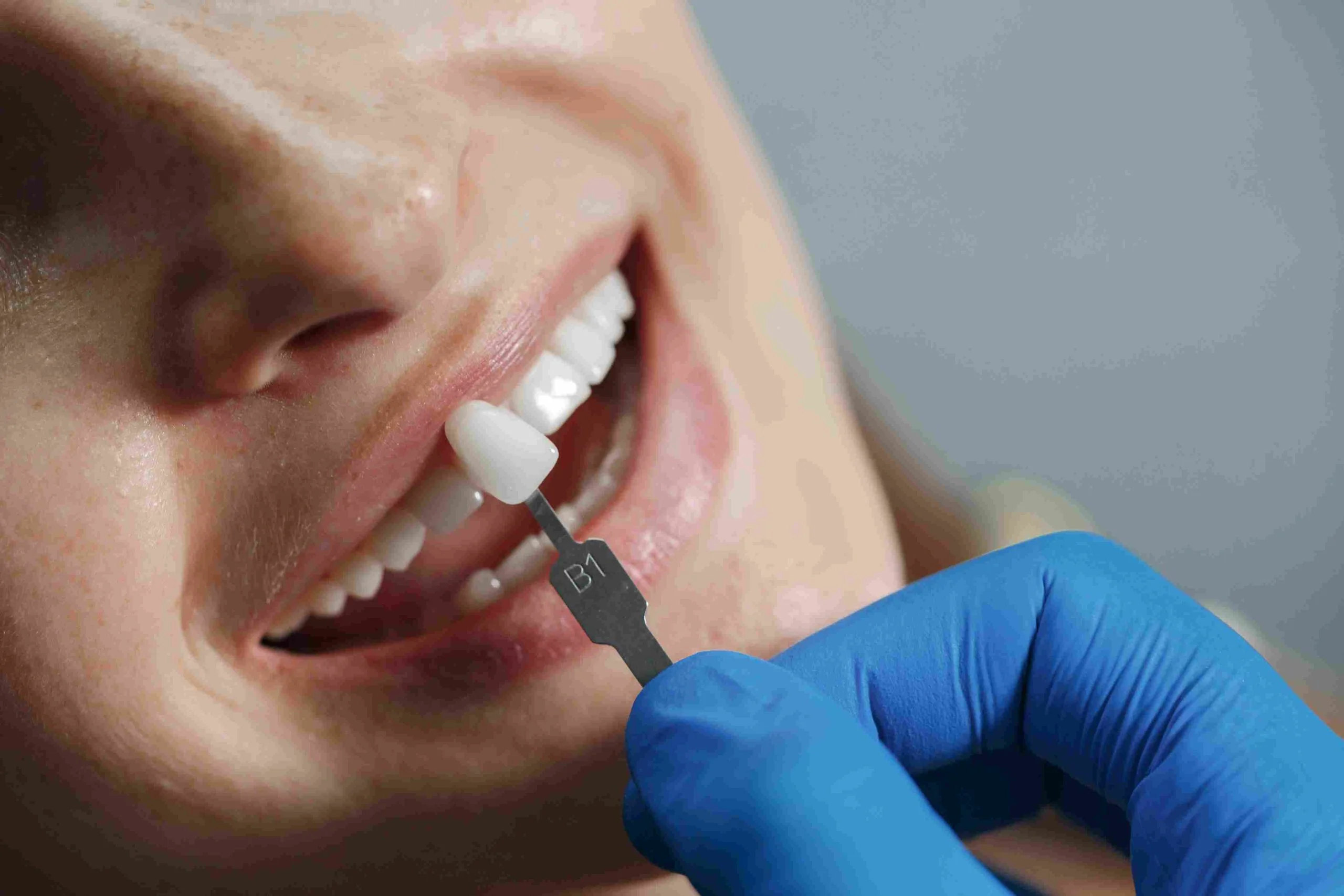Veneers - Dentistry of Orlando